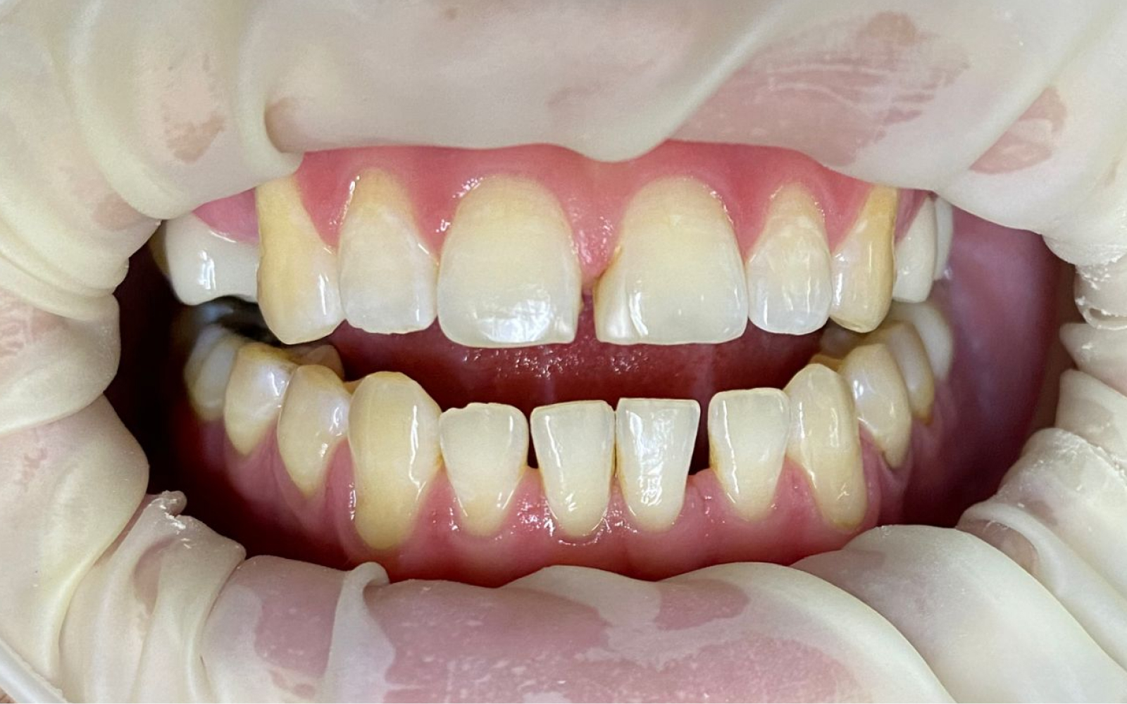 After Smile 1