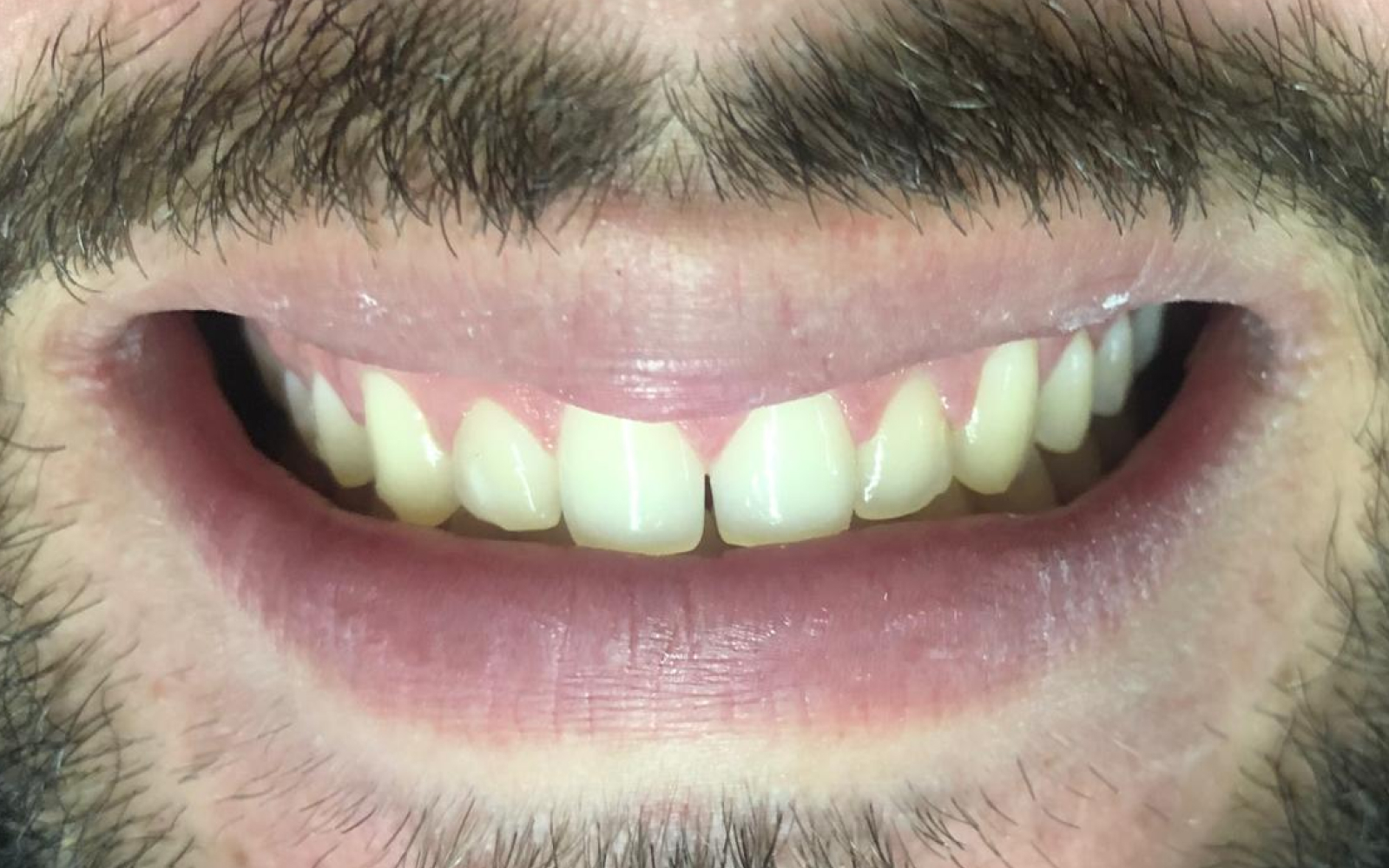 Before Smile 2