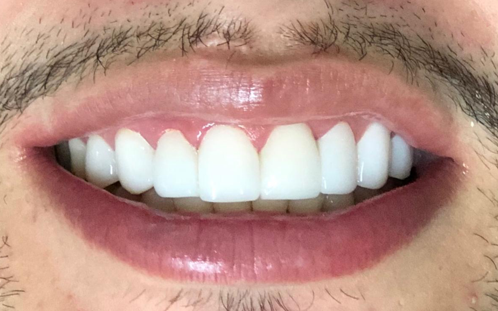 Before Smile 5