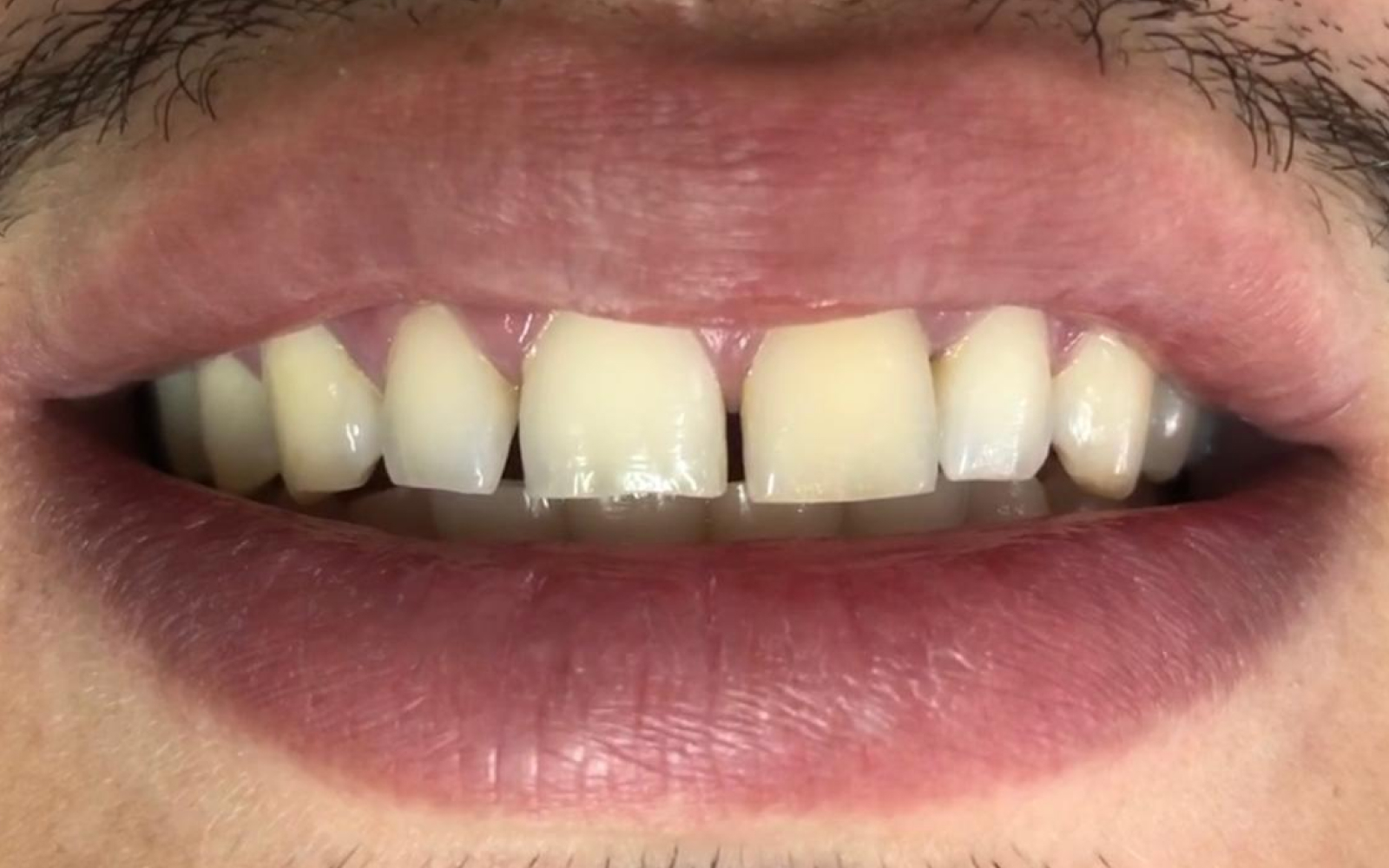 After Smile 5